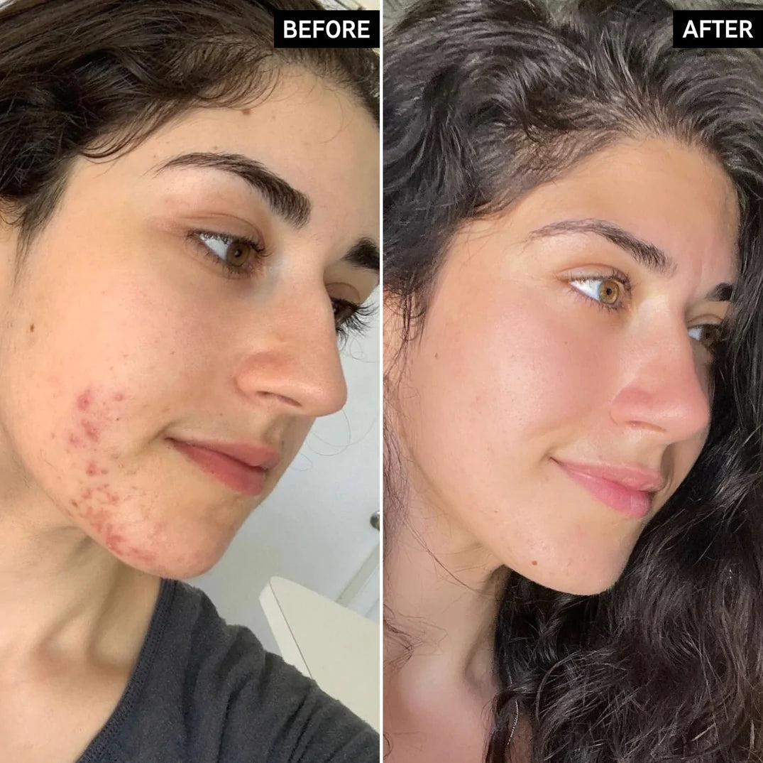 Succinic Acid Acne Treatment de The Inkey List