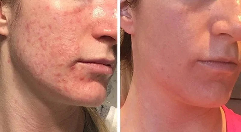 Kit Effaclar La Roche Posay